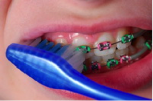 braces care